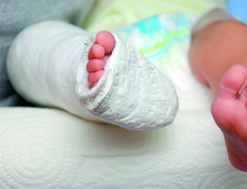 Image : Plâtre pour correction de pied bot.