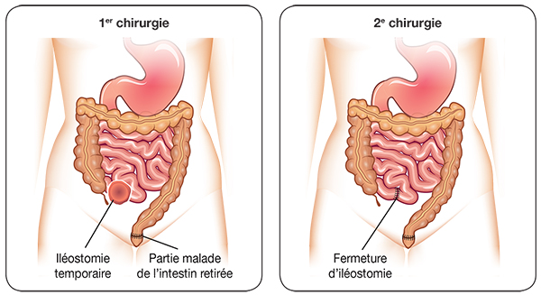 Explication de l'iléostomie et colostomie temporaire.