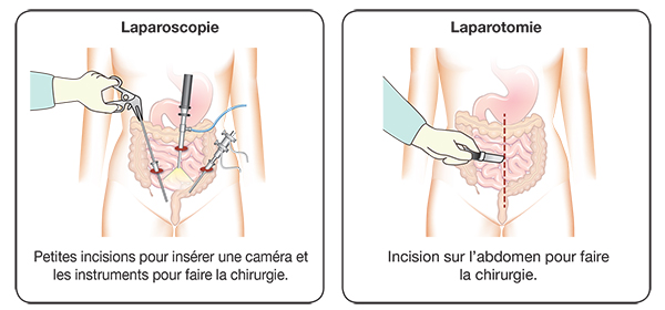 Deux techniques chirurgicales peuvent être utilisées : la laparoscopie ou la laparotomie.
