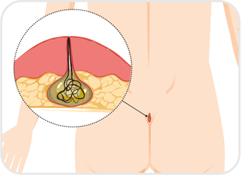 Illustration d'un kyste pilonidal, on voit un trou qui contient du liquide et des poils.