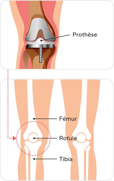 Illustration de la prothèse, une partie est connectée au fémur, et l'autre partie au tibia, on peu voir aussi une illustration des os de la jambe, le fémur est l'os qui se retrouve dans le haut de la jambe, la rotule se retrouve au milieu du genou et le tibia est l'os qui se retrouve dans le bas de la jambe.