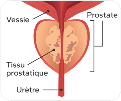Illustration d'une prostate avec hypertrophie bénigne. Au centre de la prostate, on voit le tissu prostatique très enflé.