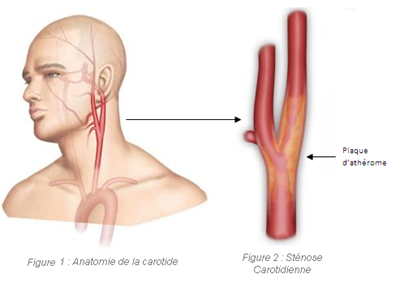 Visualisation de l'anatomie de la carotide et d'une sténose carotidienne.