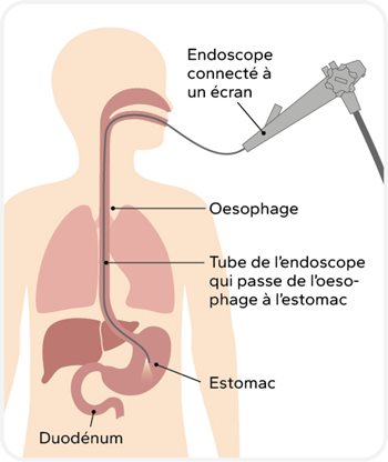 Illustration d'une endoscopie digestive montrant un endoscope (caméra) passant par la bouche, l’œsophage, l’estomac jusqu’au duodénum.
