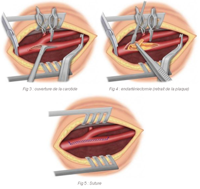 On voit l'ouverture de la carotide, le retrait de la plaque et la suture.