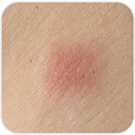 On voit un gros plan sur une tache rouge un peu gonflée sur la peau.