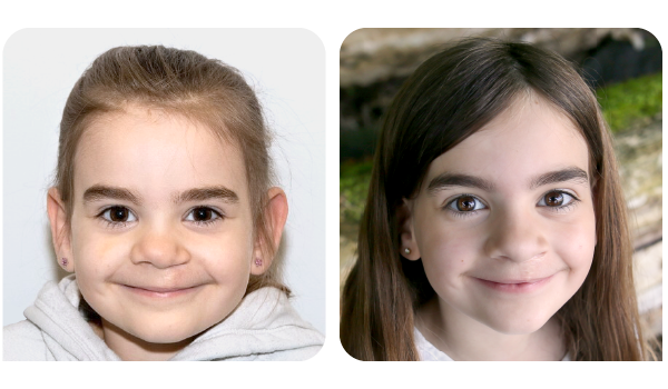 Photos avant et après la chirurgie. La jeune Marianne a également bénéficié d'une chirurgie de greffe osseuse à l'âge de 5 ans. Deux photos de Marianne après la chirurgie