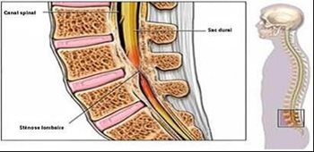 Sténose lombaire
