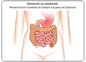 Explication d'une iléostomie ou d'une colostomie.