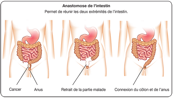Visualisation de l'anastomose de l'intestin