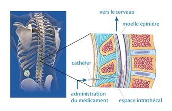 Thérapie inthatécale