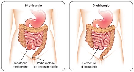 Visualisation des 2 chirurgies lorsque c'est temporaire