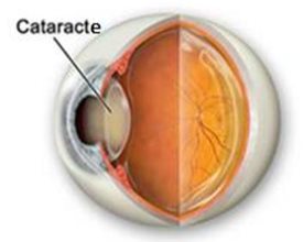 Cataracte