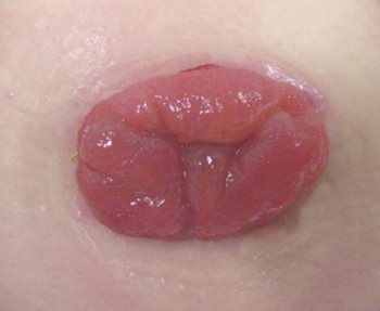 Photographie médicale d'une stomie à un orifice.