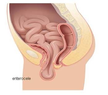 Entérocèle