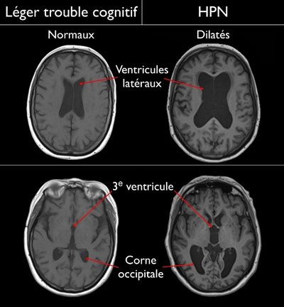 Image du cerveau montrant un état normal et un état avec trouble cognitif.