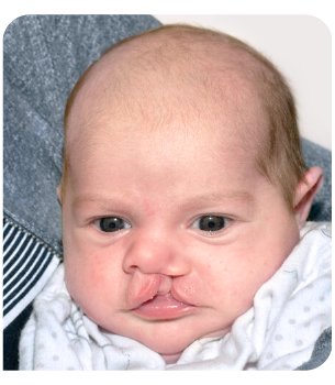 Photo de Marianne avant la chirurgie