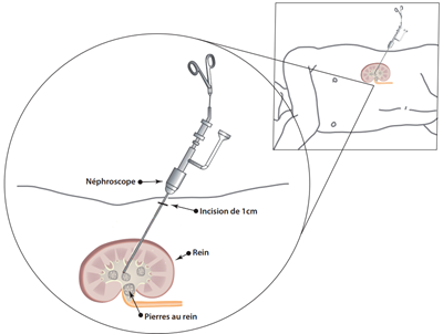 Retrait de la pierre aux reins
