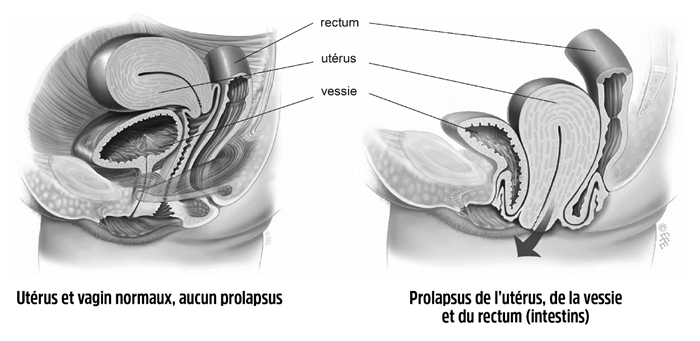 Image d'une descente d'organe.