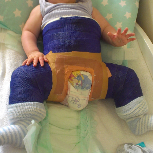 Photo d'un bébé portant un plâtre SPICA.