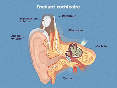 Illustration démontrant comment un implant cochléaire est installé.