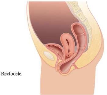 Rectocèle