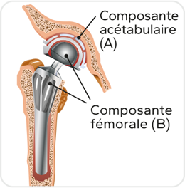 Illustration des deux composantes de la prothèse totale, elles sont en métal, la composante acétabulaire est placée sur l'os du bassin et la composante fémorale remplace la partie supérieure du fémur.