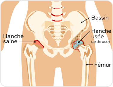 Illustration d'une hanche saine et usée, on voit sur hanche usée que le cartilage se décompose.
