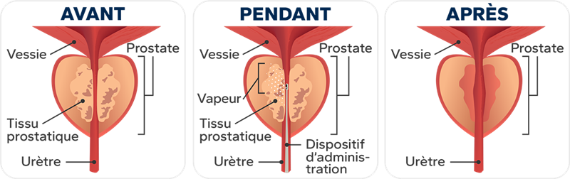 Illustration où on peut voir le avant, pendant et après le traitement. Dans le avant on voit le tissu prostatique très enflé, pour le pendant on voit que de la vapeur est envoyé sur le tissu prostatique par un petit tube qui entre par l'urètre et dans le après on voit que l'enflure est complètement disparue.