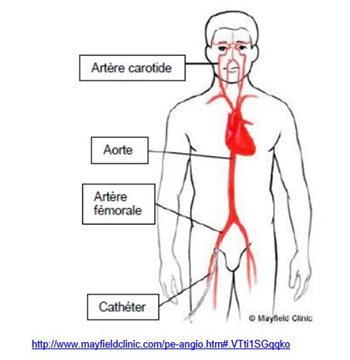 On voit l'artère carotide, l'aorte, l'artère fémorale et le cathéter.